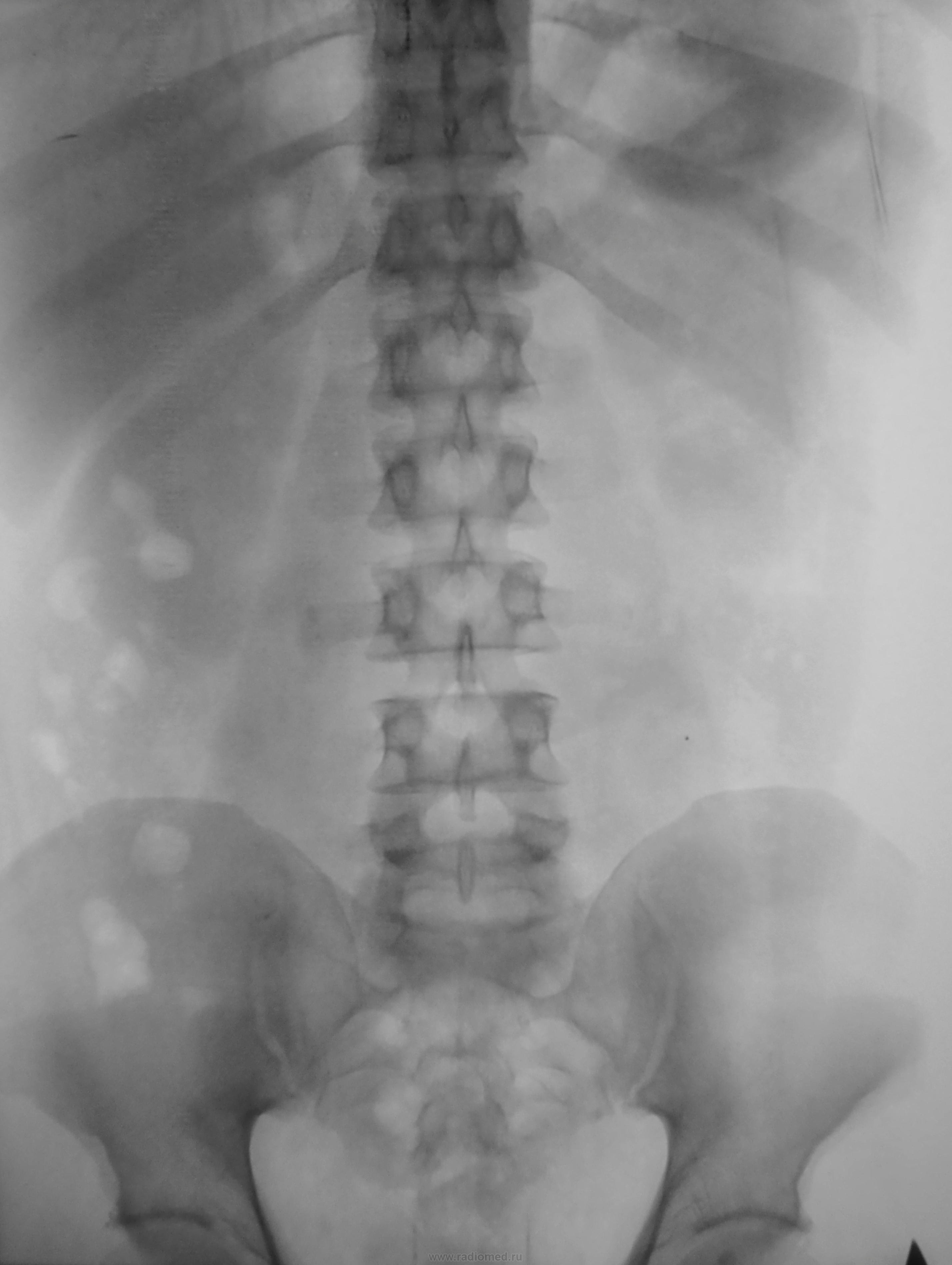 Снимок почек. Рентген почек и мочевыводящих путей. Обзорная рентген почек и мочевыв путей. Обзорная рентгенограмма мочевыводящих путей камни. Обзорный рентген почек и мочевыводящих путей.