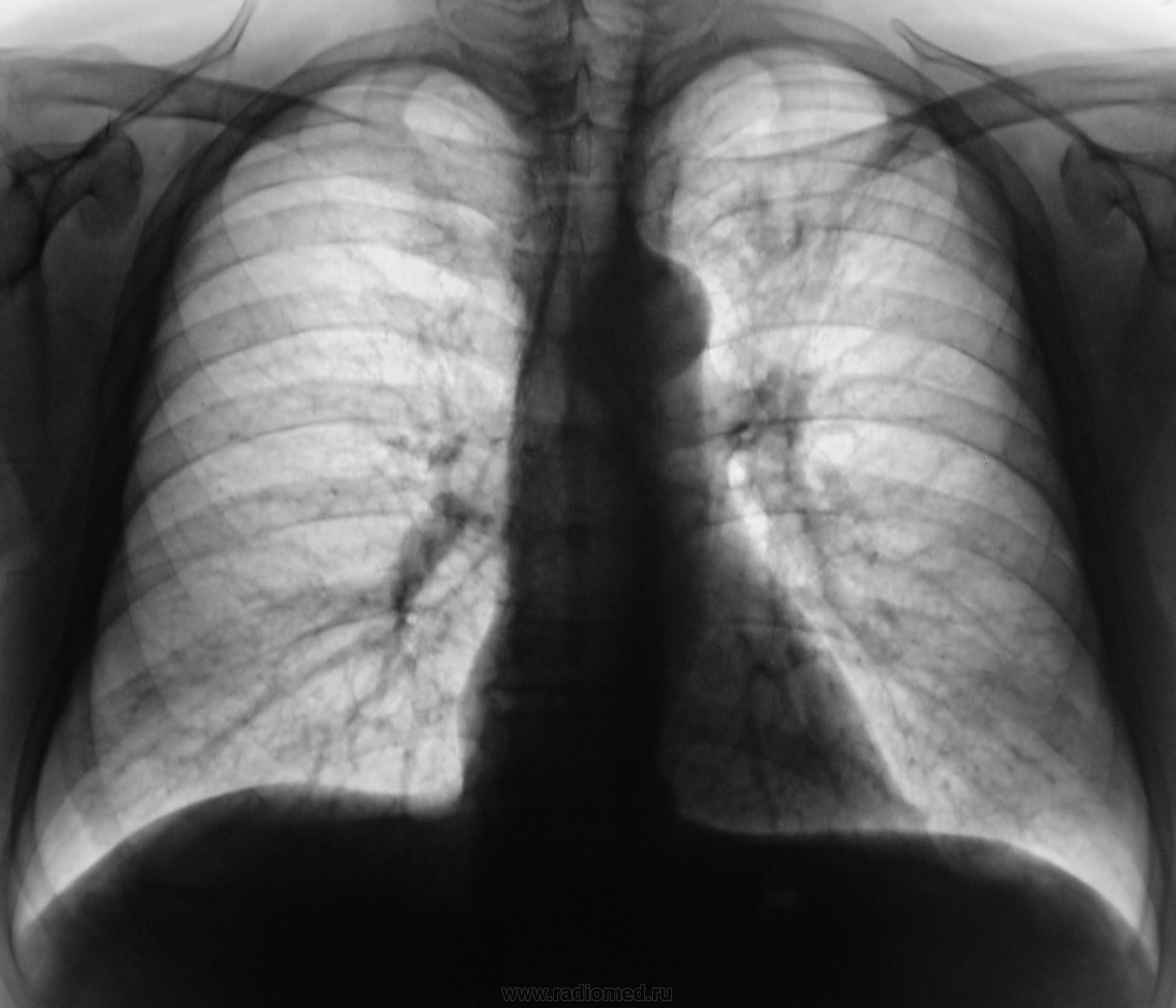 Черные точки на легких. Танталовый шов на легком рентген. Флюорография легких курильщика. Снимок флюорографии курильщика.