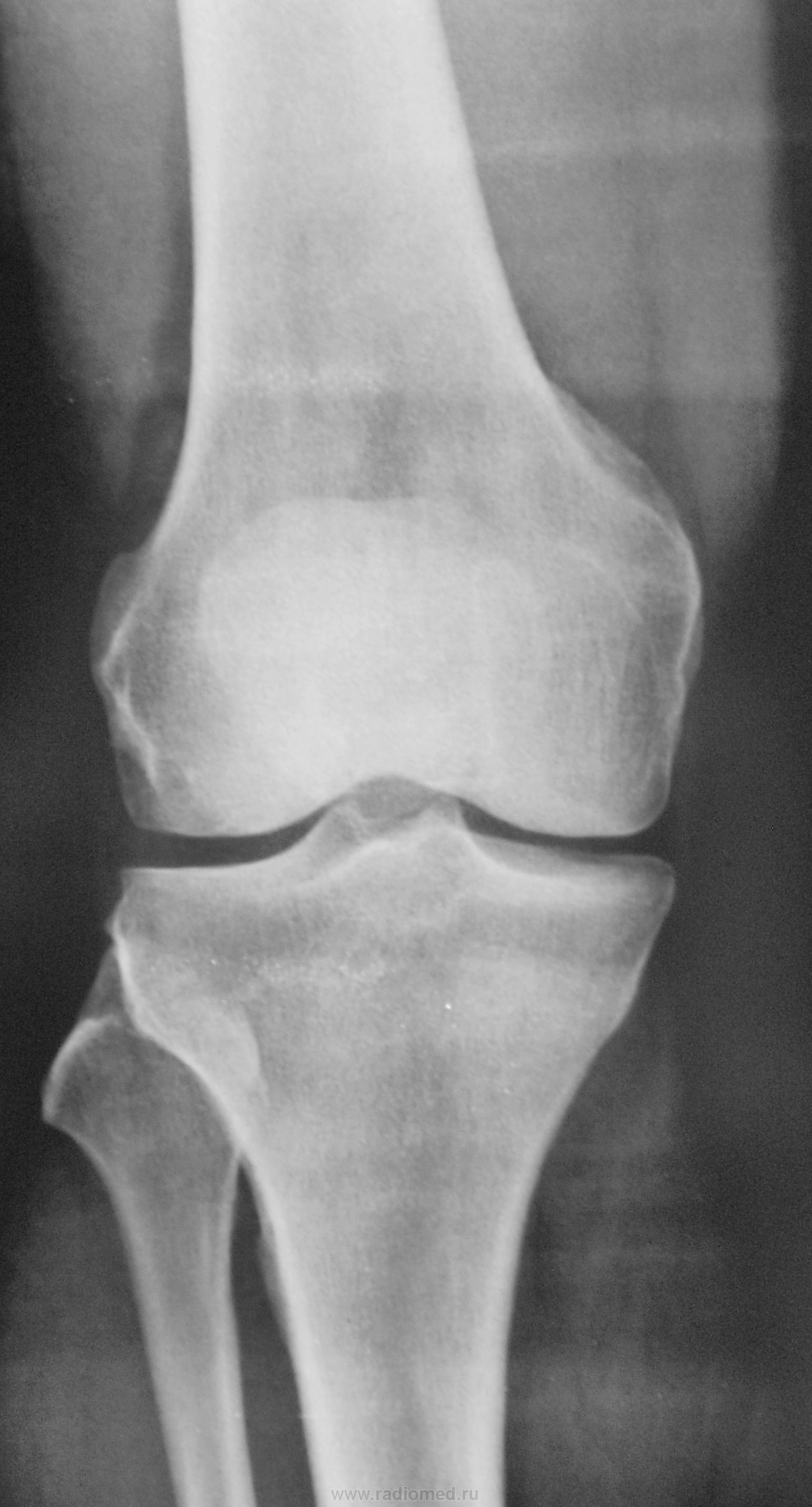 Рентген колена. Гемартроз коленного сустава рентген. Менископатия коленного сустава рентген. Мениск коленного сустава рентген. Гемартроз на рентгене колена.
