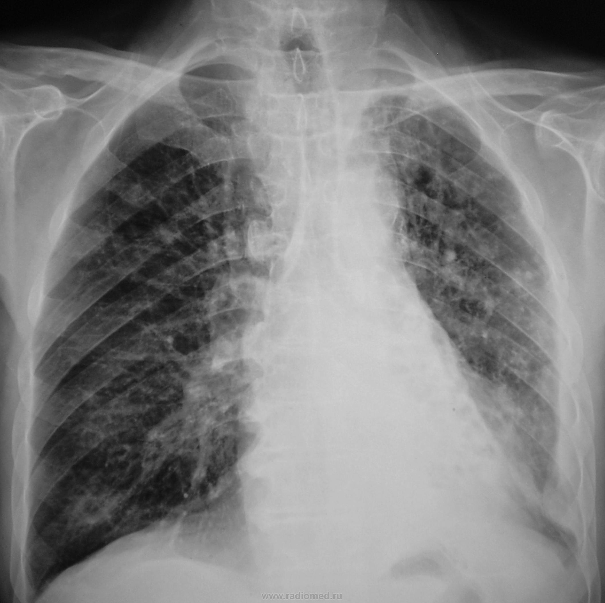 Поражением легких 50. Коронавирус пневмония рентген. Рентген снимок ОГК. Снимки легких.