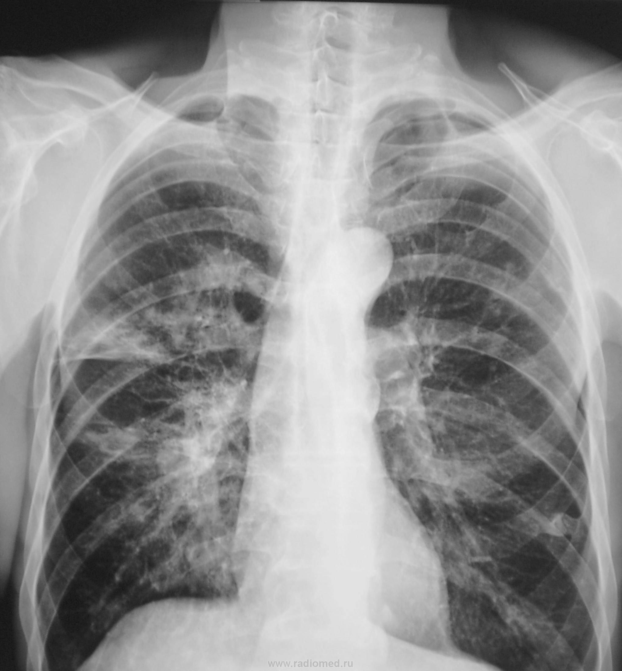 Очаговая пневмония рентгенография ОГК