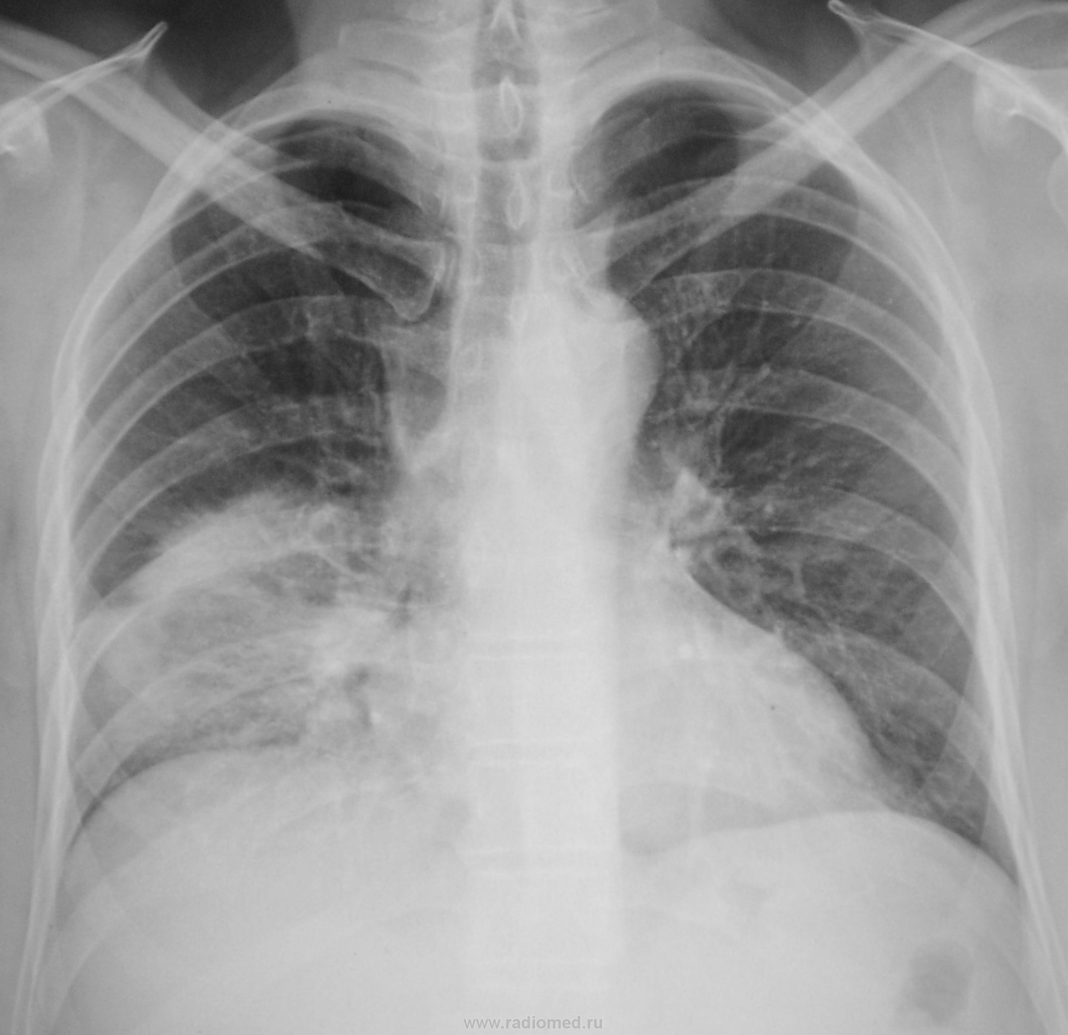 Внебольничная очаговая пневмония рентген