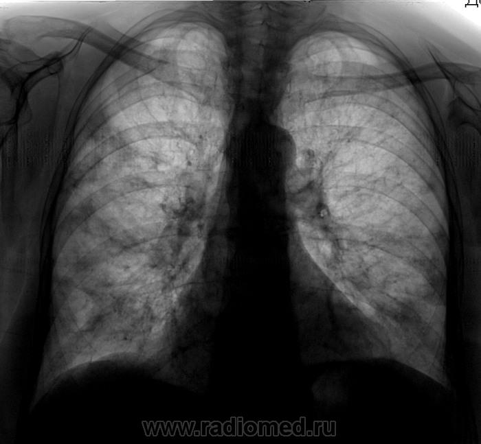 Флюорография легких. Флюорография рентген легких курильщика. Снимок флюорограмма туберкулез. Рентген легких курильщика рентген легких курильщика. Легкие курильщика на флюорографии.