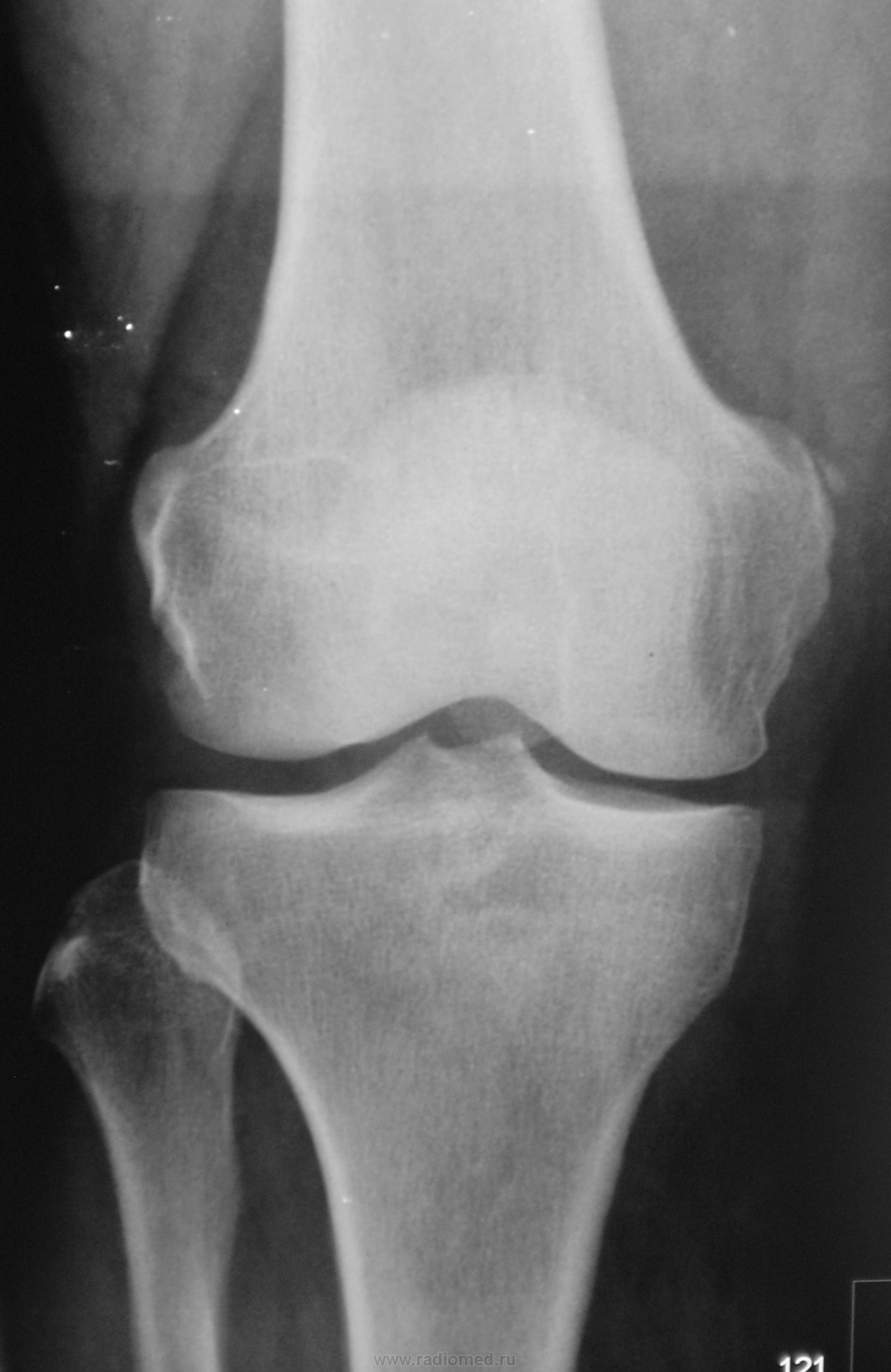 Рентген колена. Болезнь Пеллегрини Штида. Пеллегрини Штида рентген. Пателлофеморальный артроз коленного сустава рентген.