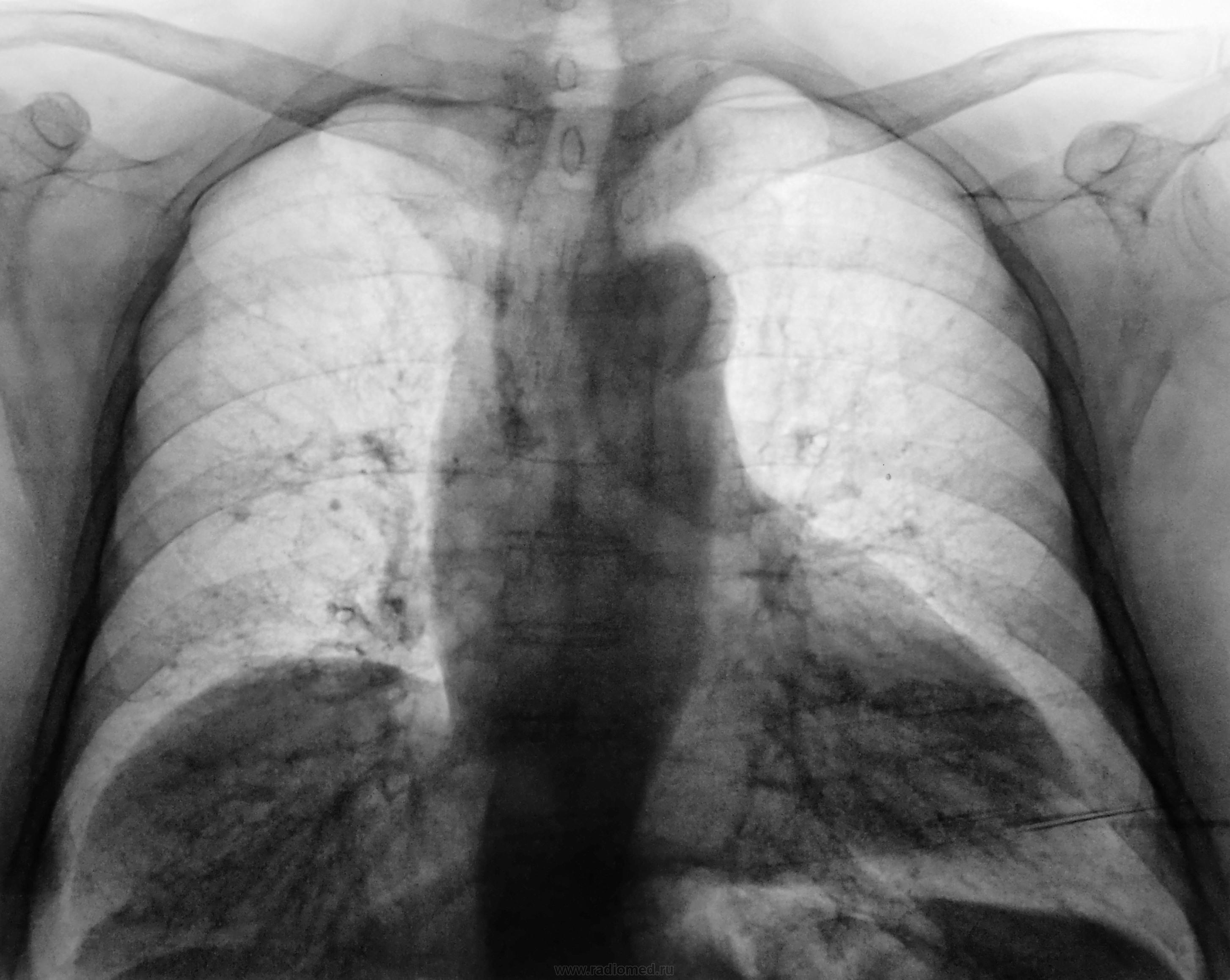 Гипостатическая пневмония рентген