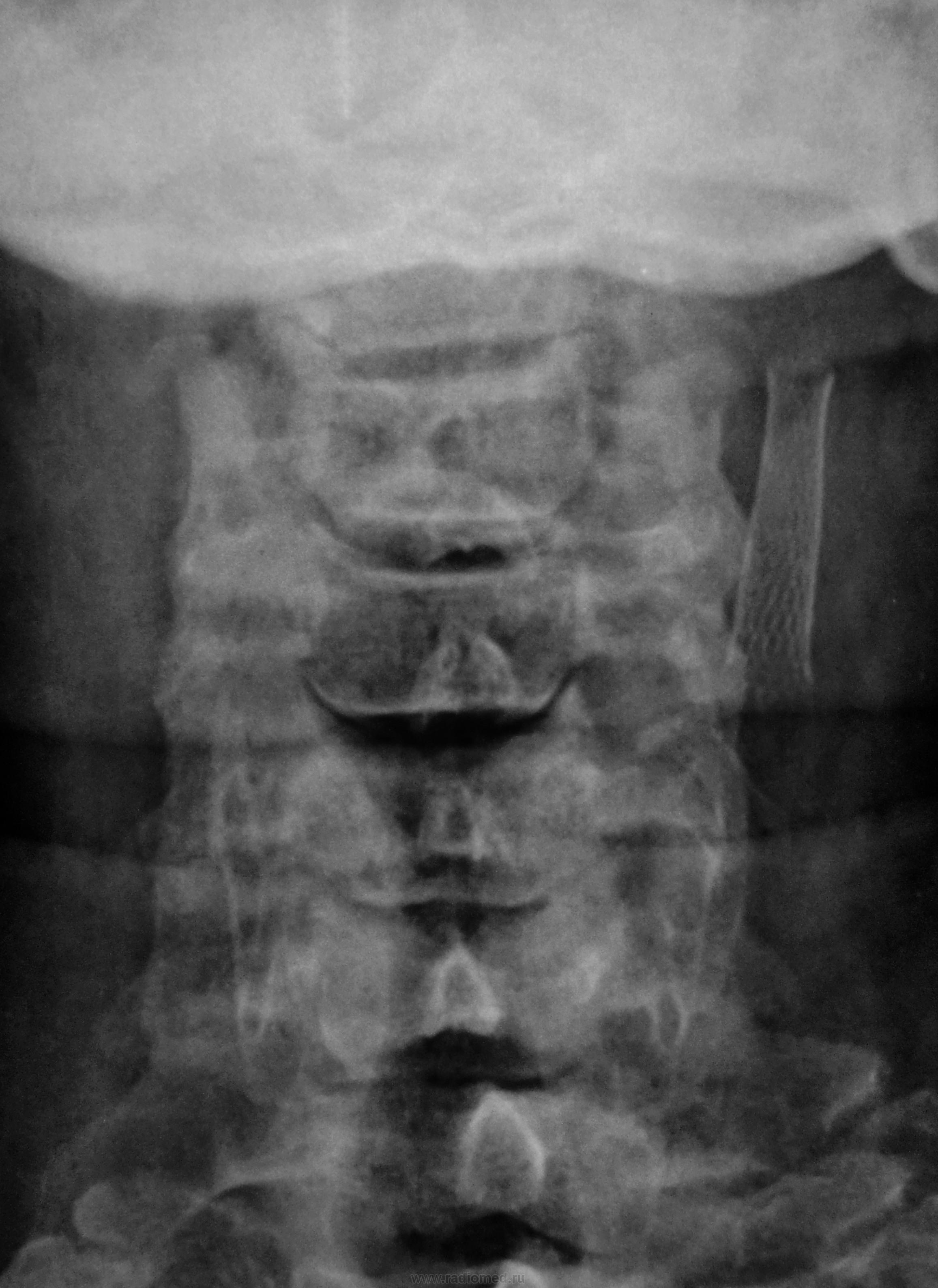 Рентген шейного отдела позвоночника. Обызвествление шейных позвонков. Метастаз шейного отдела позвоночника рентген. Опухоль шейного отдела позвоночника на рентгене. Рентгенограммы шейного отдела позвоночника с метастазами.