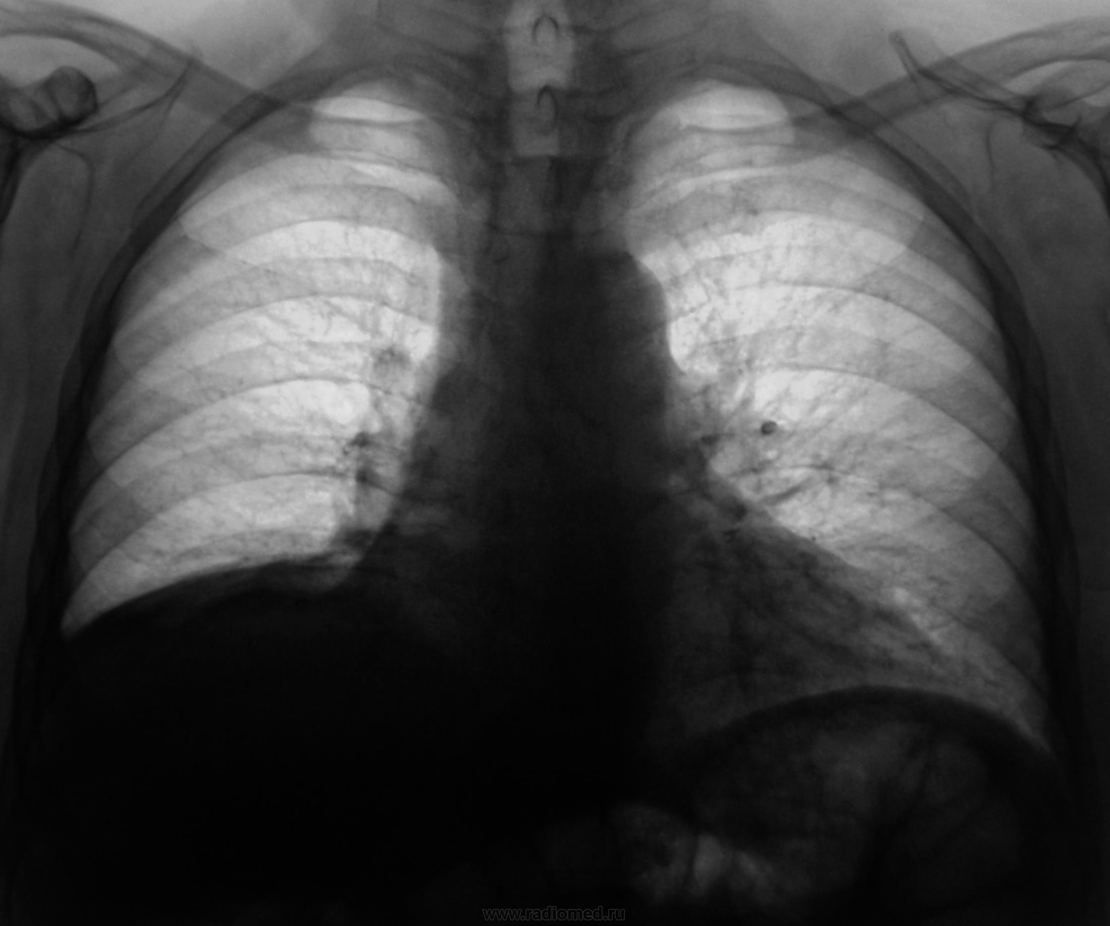 Диагноз правосторонний. Плеврит снимок рентген. Плевральный выпот рентгенограмма. Плащевидный плеврит рентген. Фиброзный плеврит рентген.