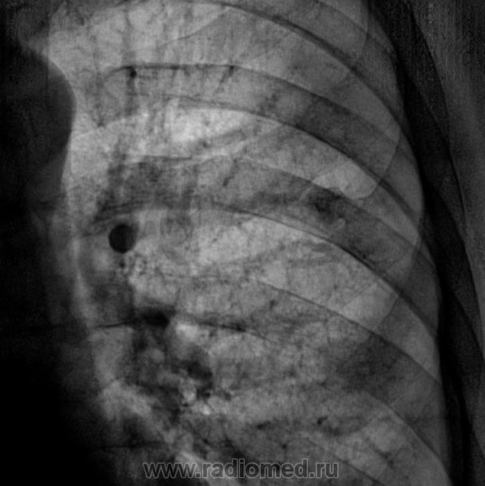 Черные точки на легких. Темные пятна на рентгеновском снимке легких. Сосуды легких на рентгенограмме.