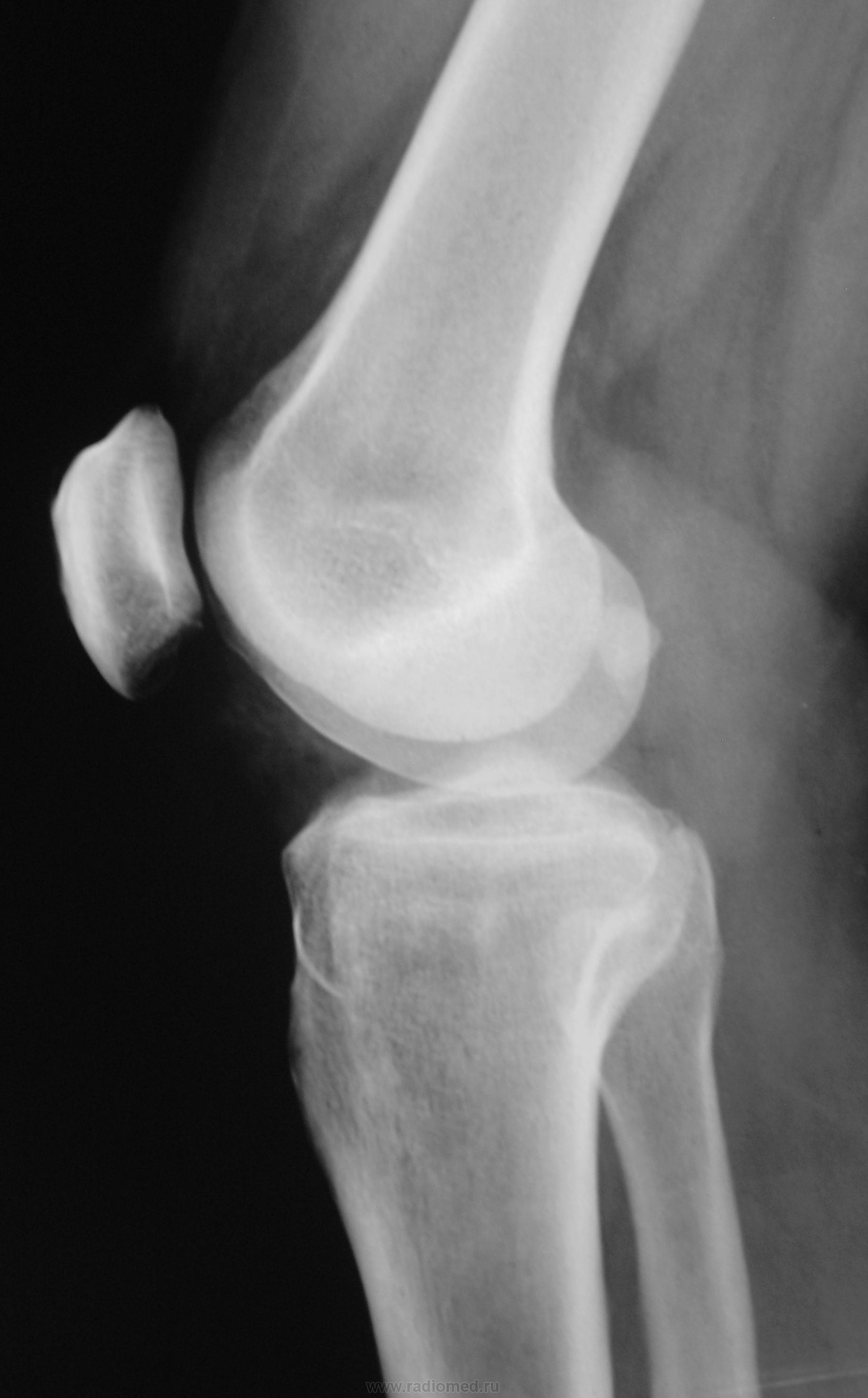 Фото рентгена коленного сустава
