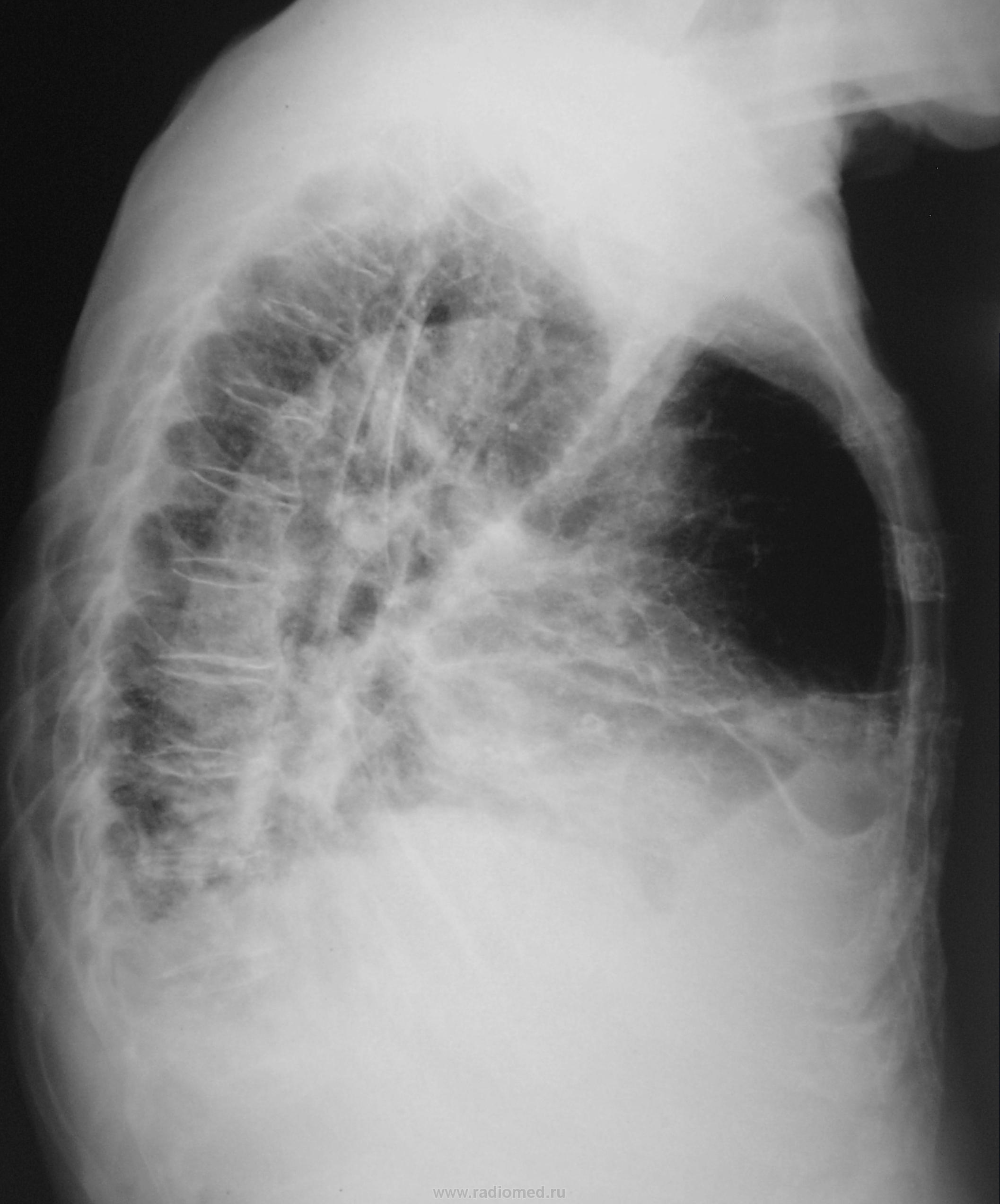 Рентгенография огк. Мицетома на рентгене ОГК. Застойная пневмония рентген.