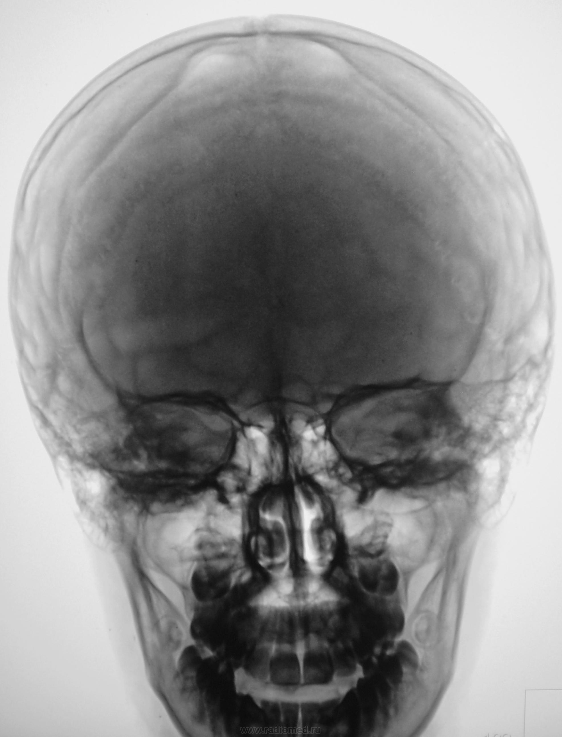 Детский череп рентген. Патология костей черепа рентген. Рентген снимок черепа норма. Рентгенограмма черепа норма.