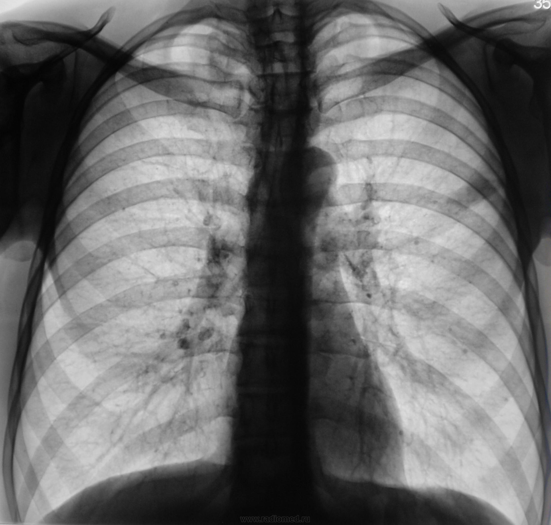 Легкие курильщика на флюорографии фото легкие и здоровые рентген