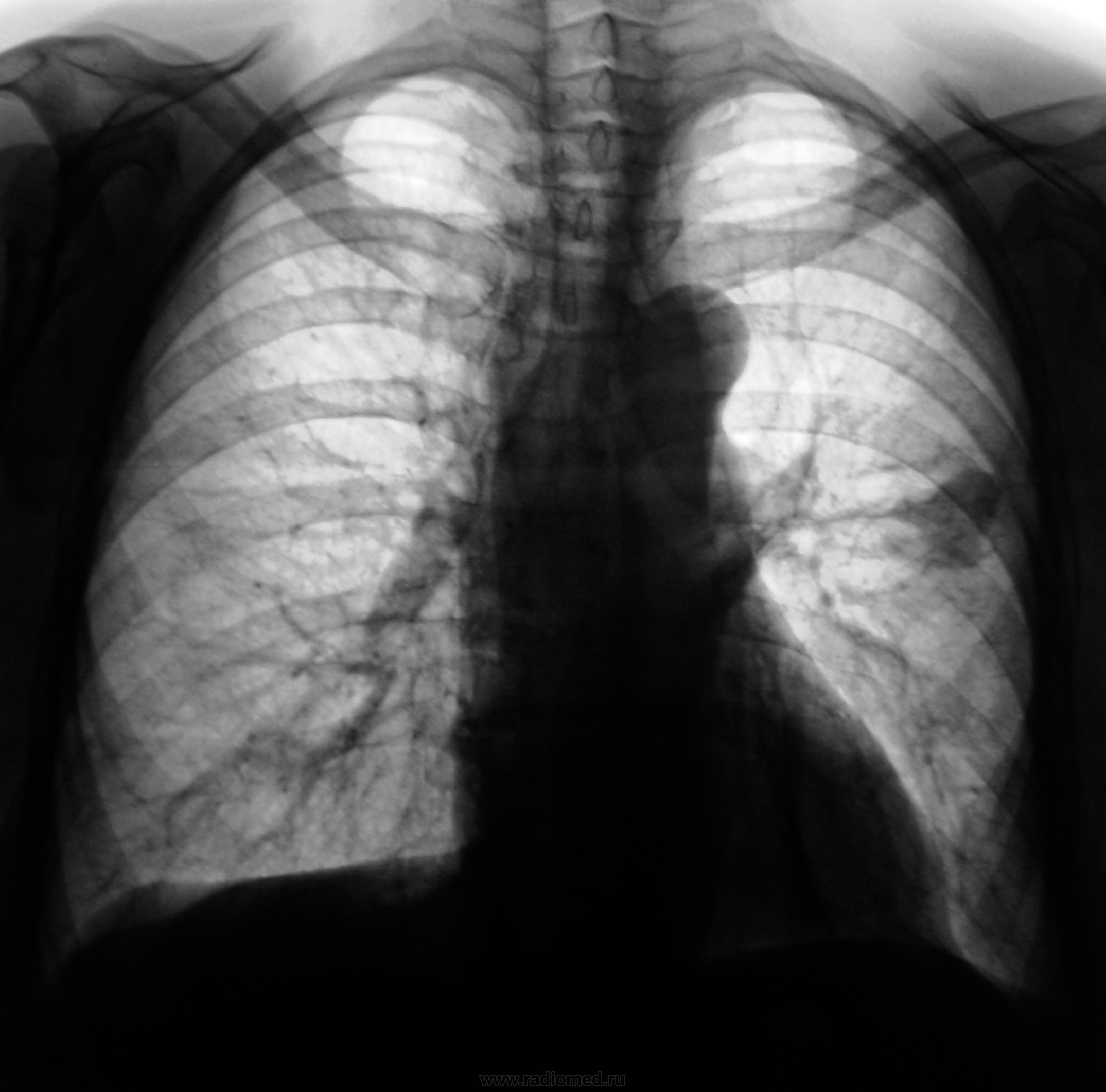 Флюорография снимок здоровых легких и больных фото