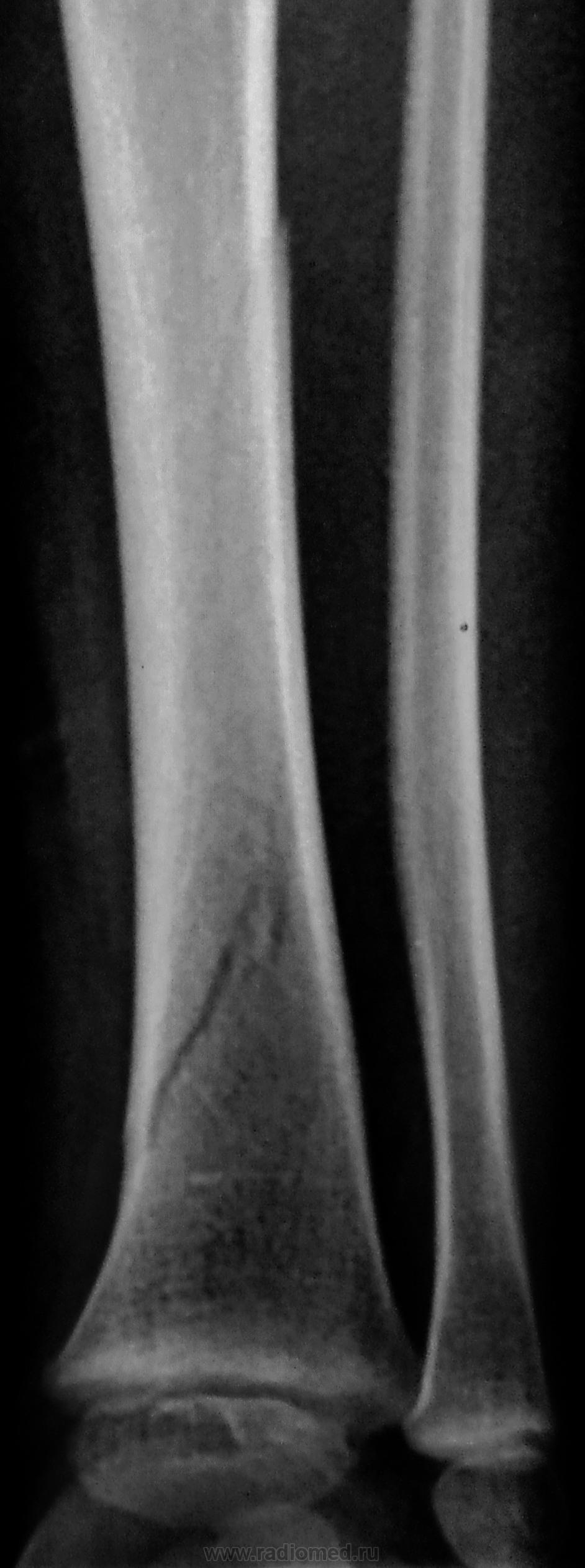 Рентген большеберцовой кости
