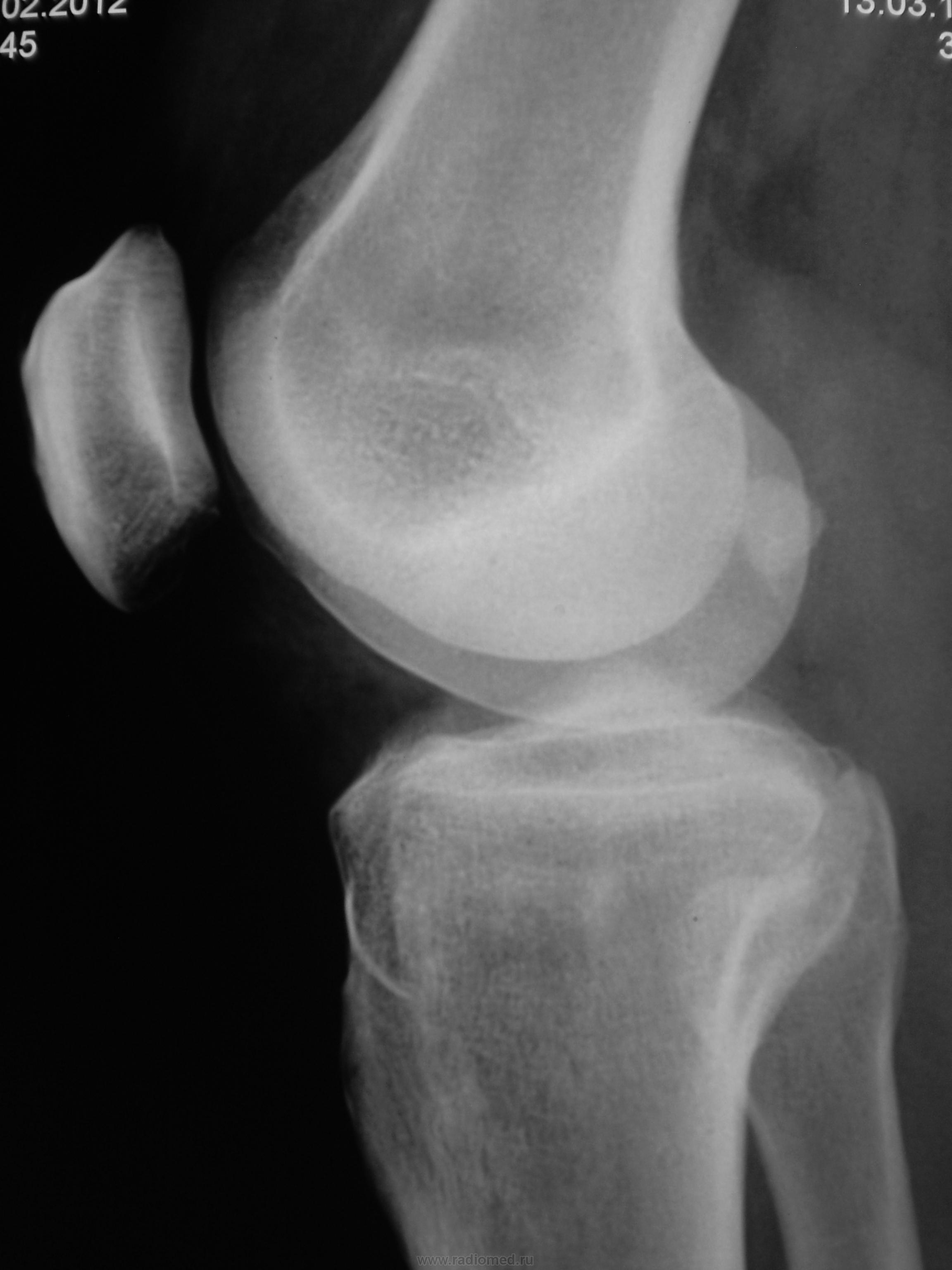 Рентген колена. Пателлофеморальный артроз коленного сустава рентген. Артроз пателлофеморального сочленения коленного сустава рентген. Рентгенограмма коленного сустава в норме. Артроз надколенника рентген.