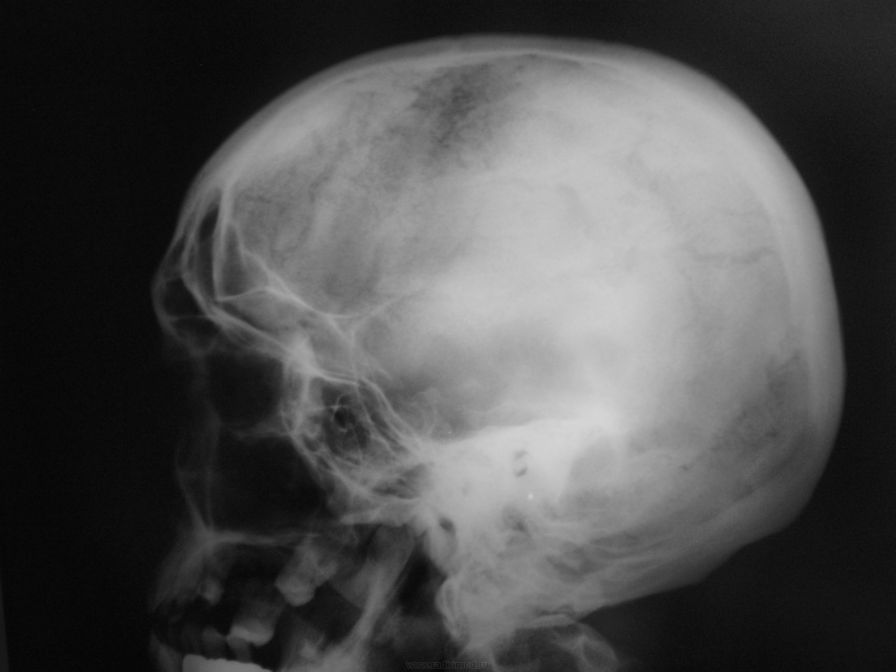 Трещина черепа у ребенка. Кости черепа рентген норма. Диплоические вены черепа рентген. Перелом костей черепа рентген. Перелом теменной кости черепа рентген.