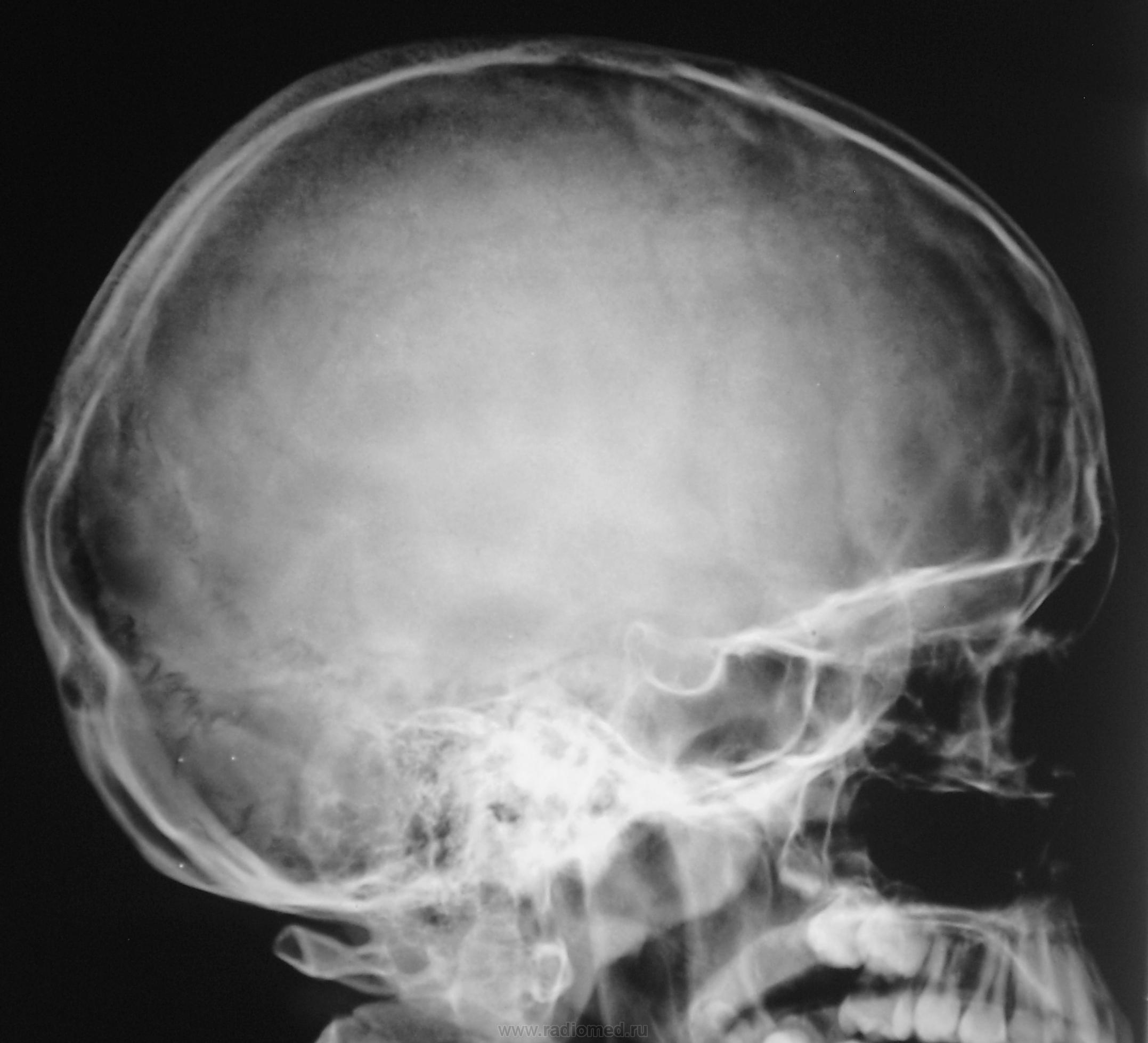 Детский череп рентген. Пальцевые вдавления на черепе рентген. Ахондроплазия рентген черепа. Синостоз костей черепа рентген.