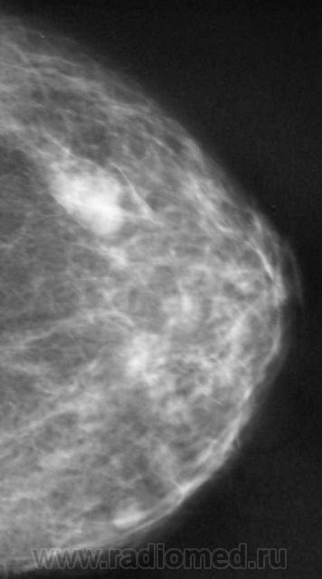 Маммография старый. Маммография белые пятна на снимке. Здоровый снимок маммографии.