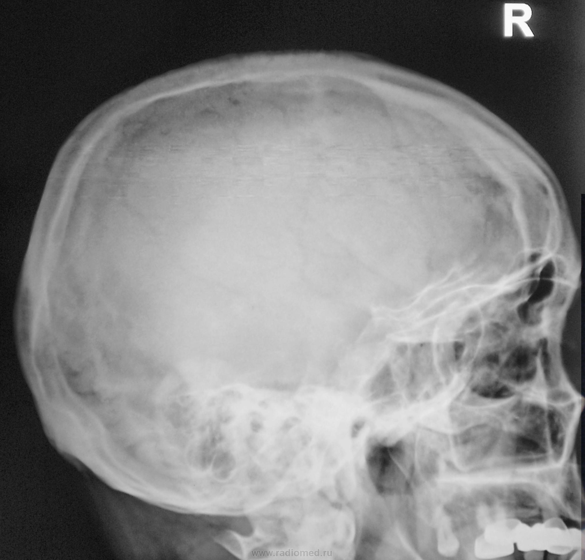 Трещина черепа у ребенка. Рентгенограмма черепа норма. Кости черепа рентген норма. Краниограмма черепа боковая рентген.