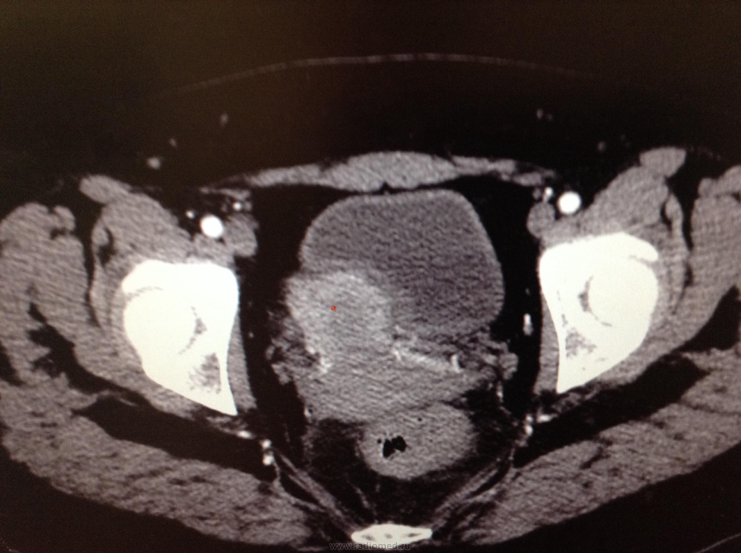 Солидное образование малого таза. Многокамерное жидкостное образование в Малом тазу что это. Образование в Малом тазу. Лимфома малого таза мрт.
