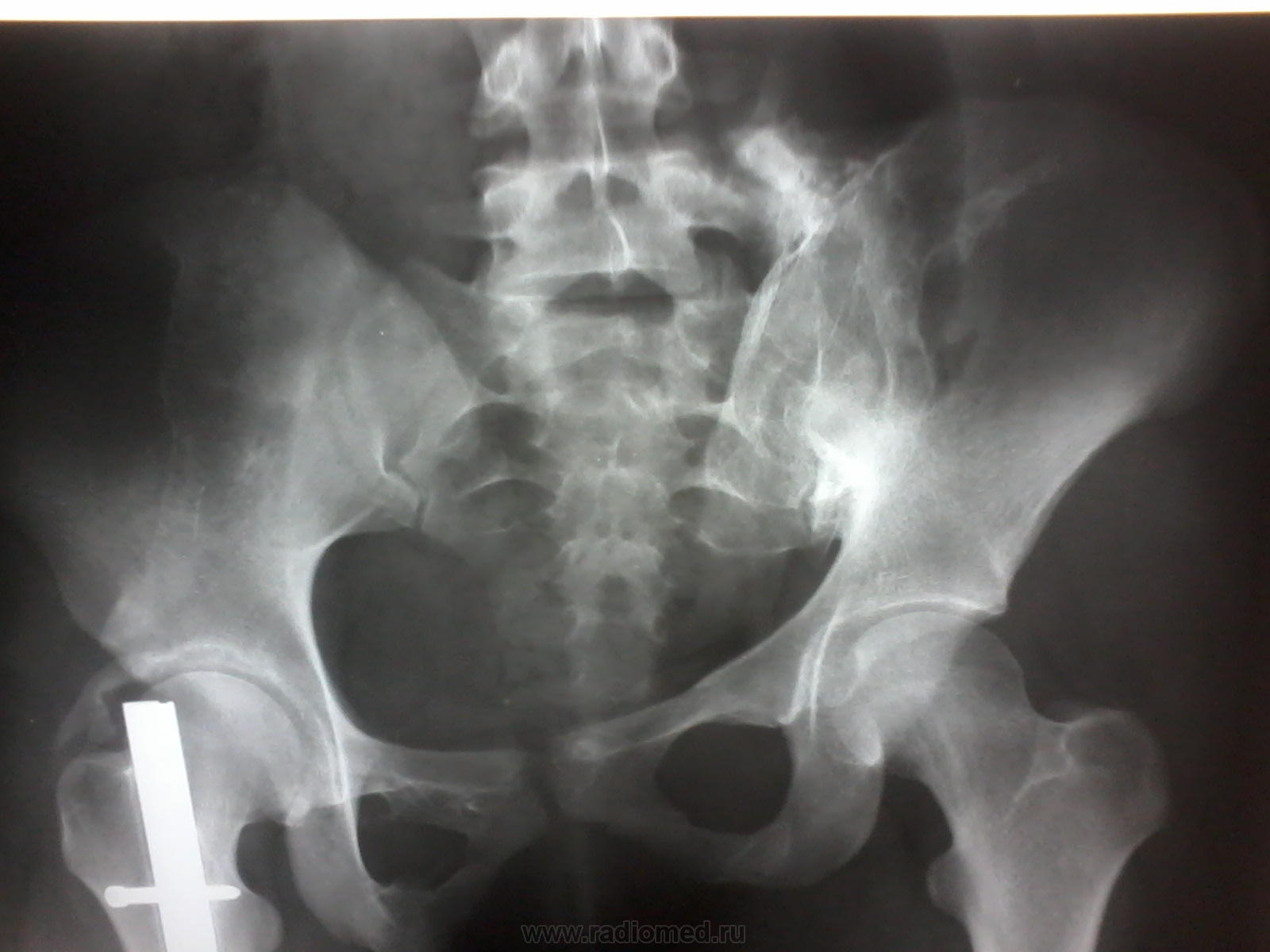 Миеломная болезнь тазовых костей рентген