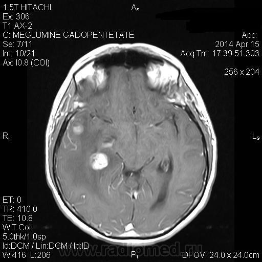 Метастазы в мозг прогноз. Метастазы головного мозга кт. Метастазы молочной железы в мозг. РМЖ метастазы в головной мозг.