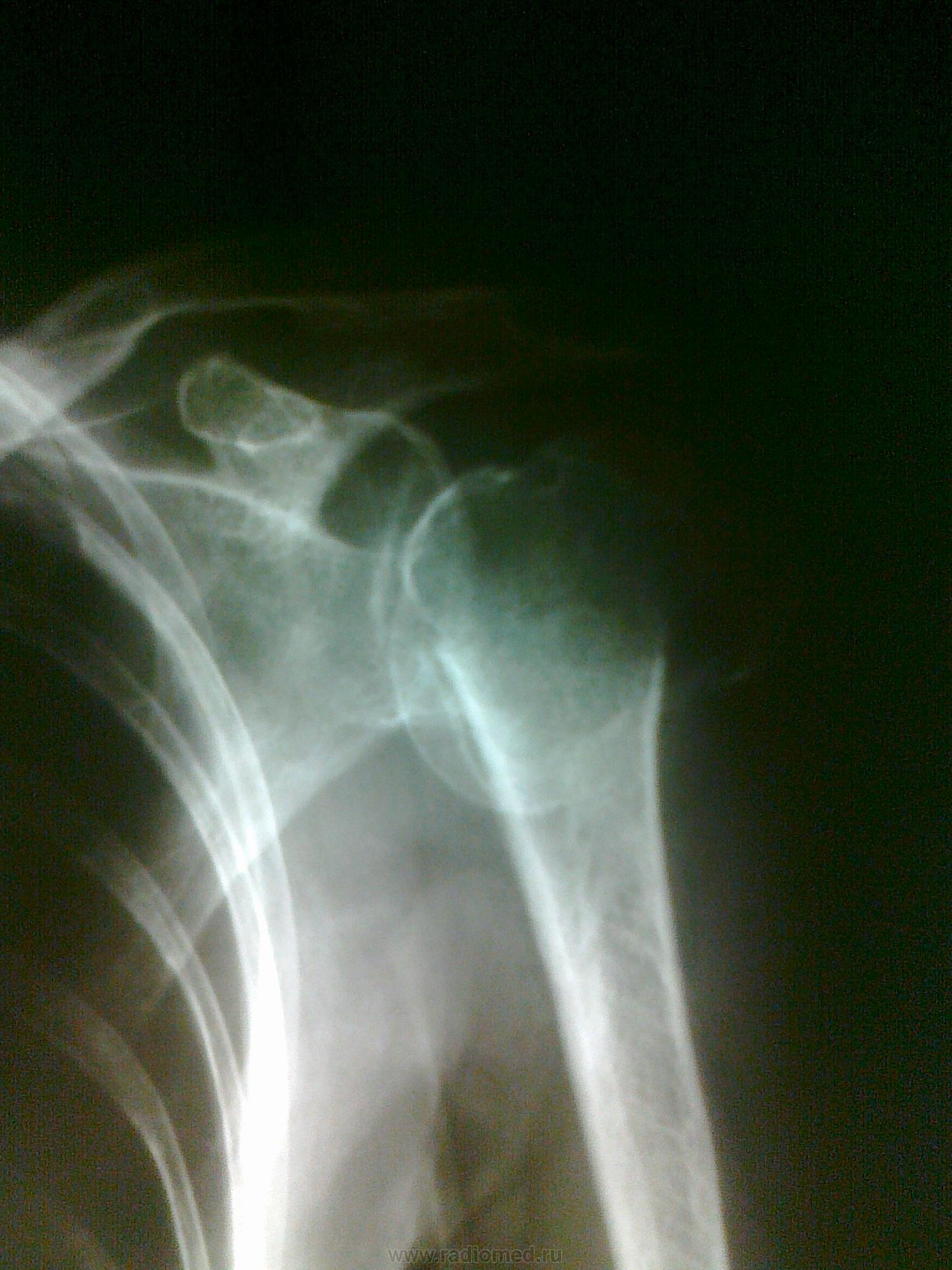 Перелом плечевой кости рентген