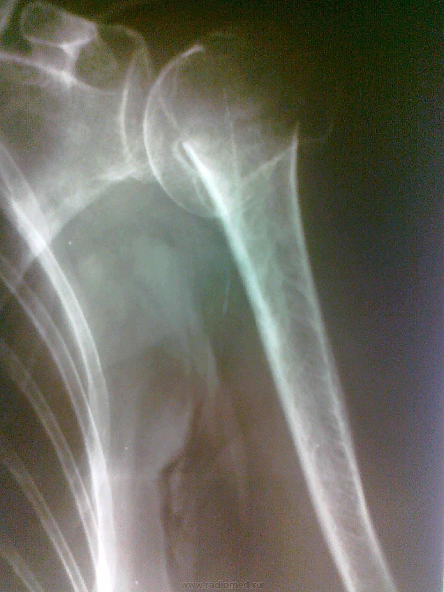 Шейка плечевой кости перелом фото