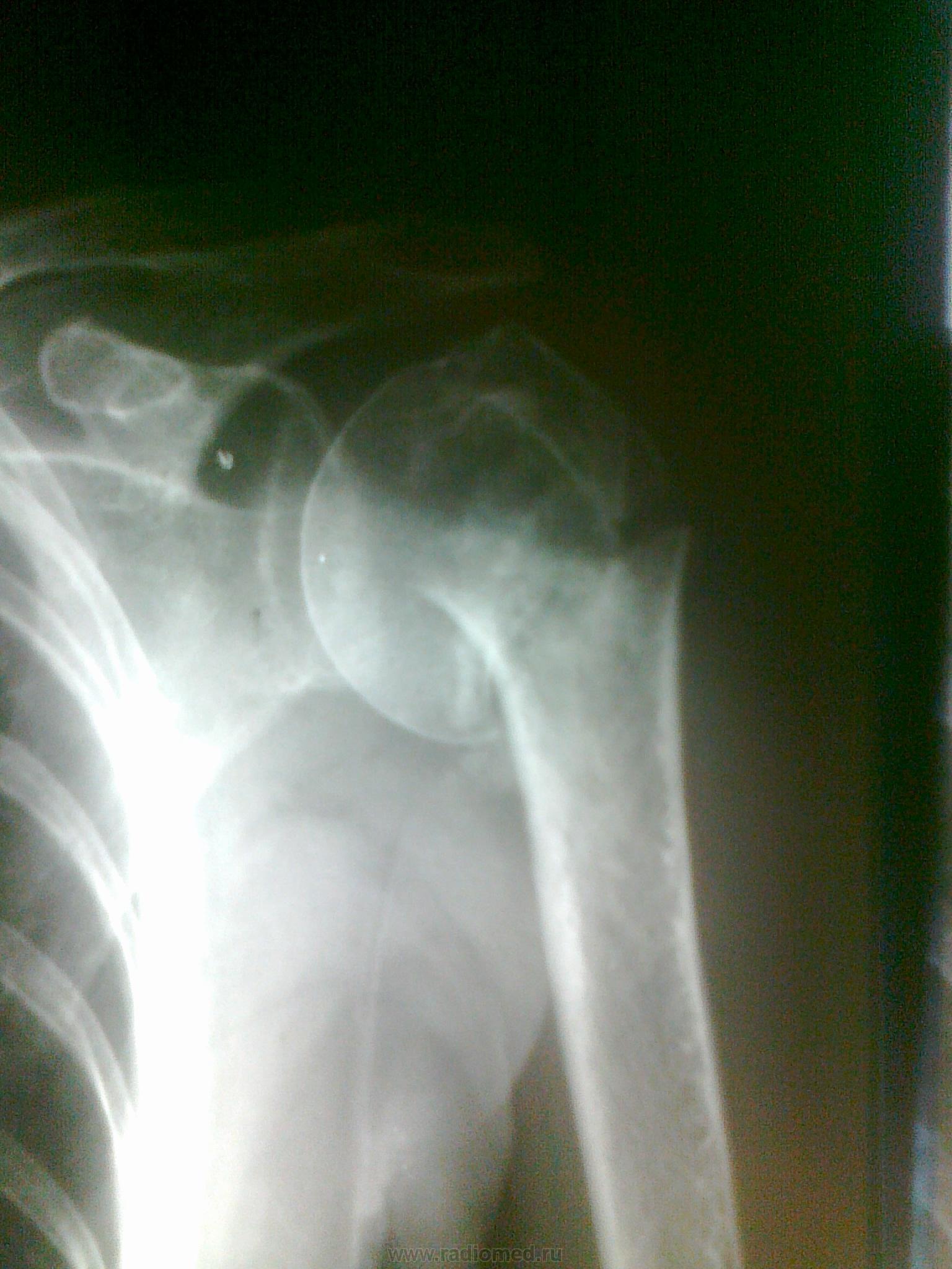 Аддукционный перелом шейки плечевой кости рентген