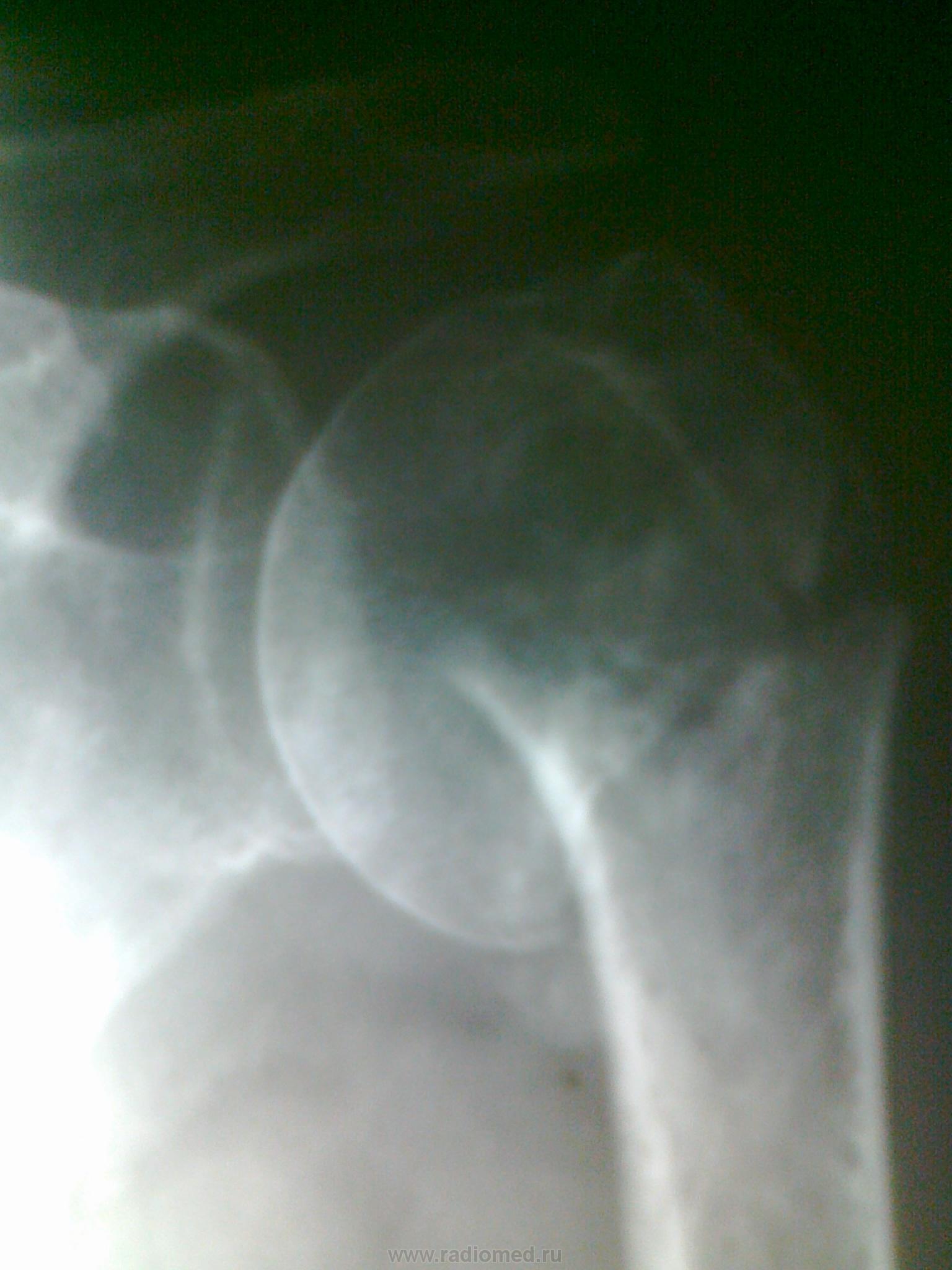 перелом плечевой кости со смещением фото