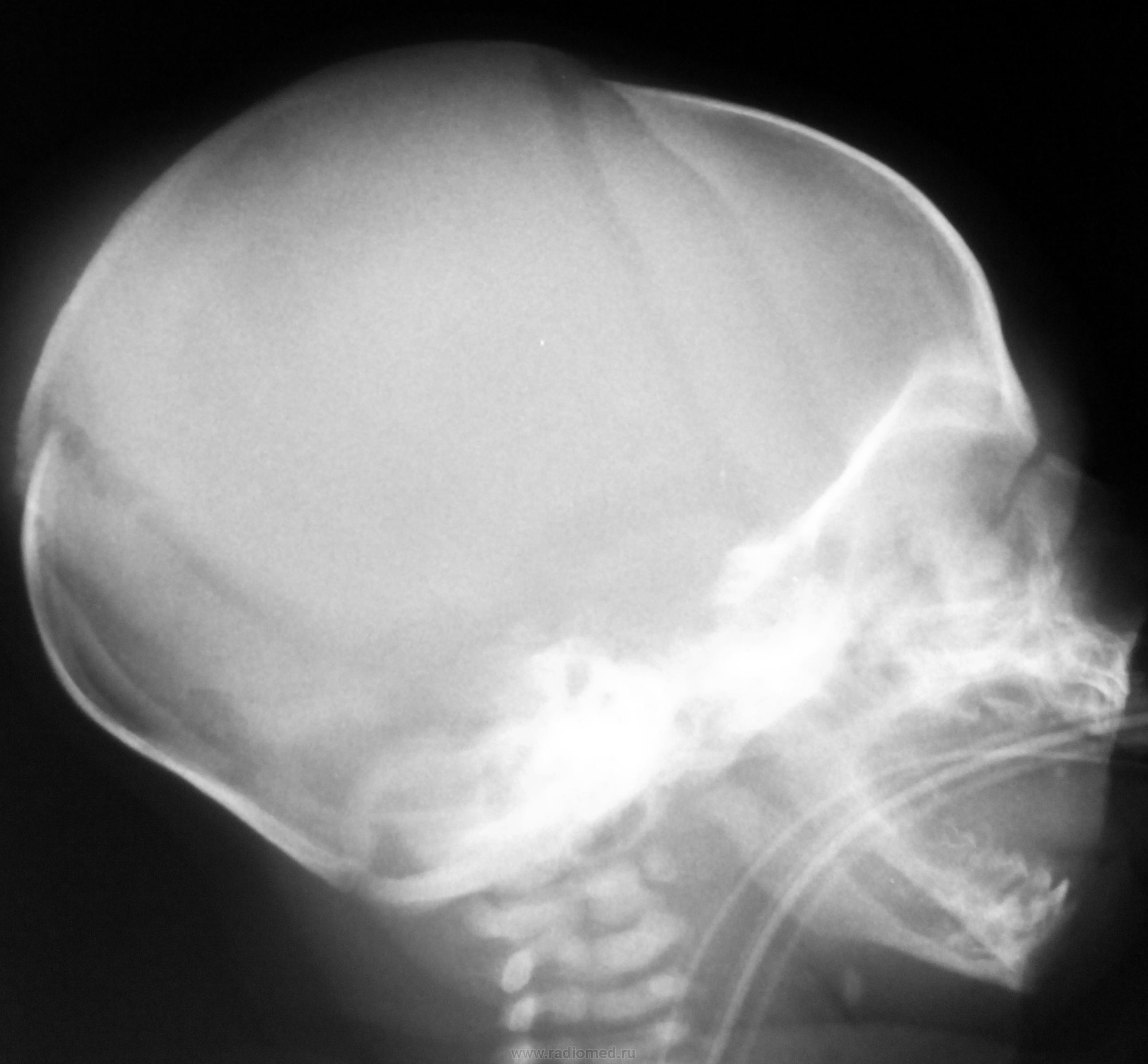 Детский череп рентген. Рентген затылочной кости. Череп новорожденного рентген норма. Снимок черепа новорожденных. Рентгенограмма черепа ребенка.