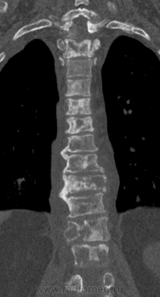 Метастазы в позвоночнике. Остеобластические метастазы позвоночника на кт.