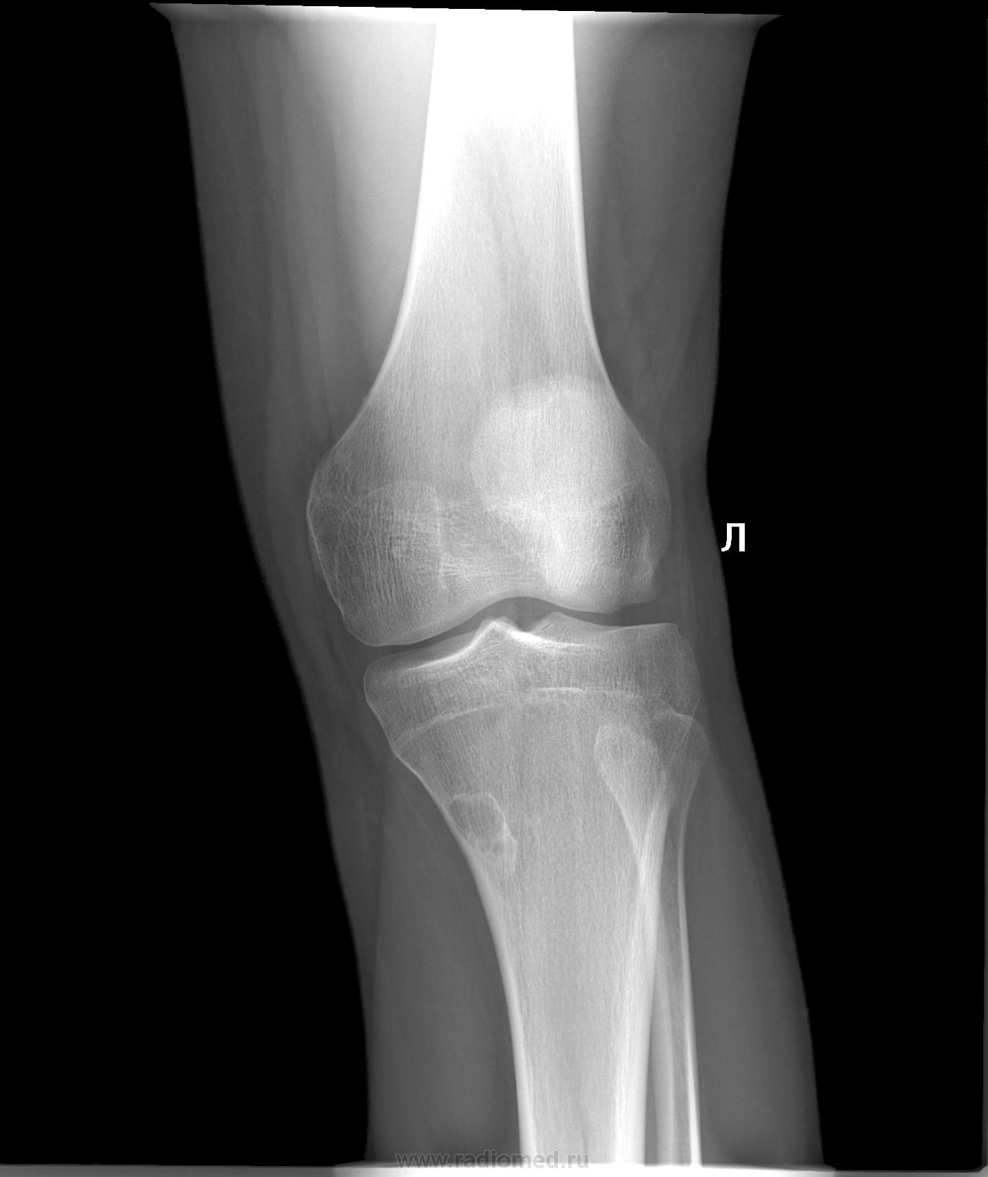 Фото здорового коленного сустава человека рентген