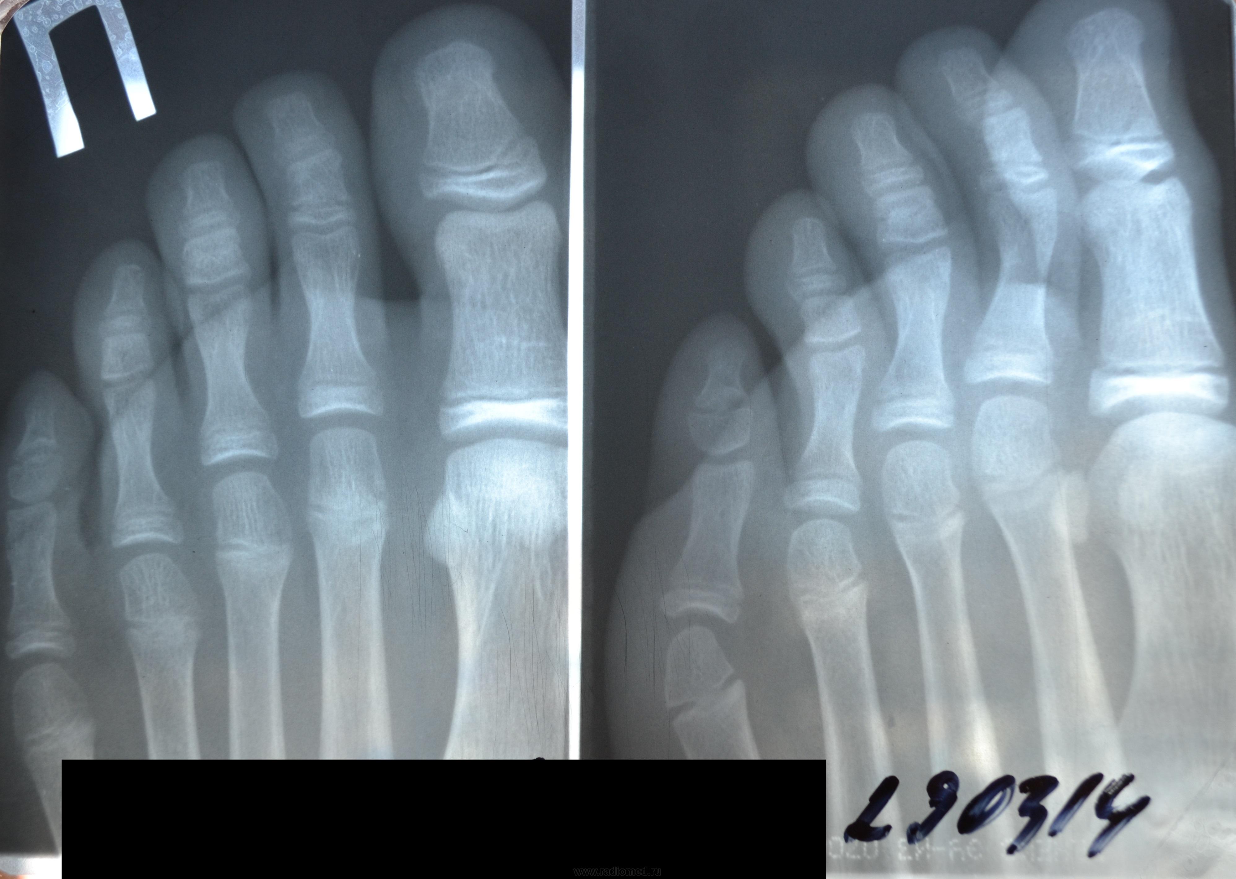 Рентген перелома дистальной фаланги 1 пальца