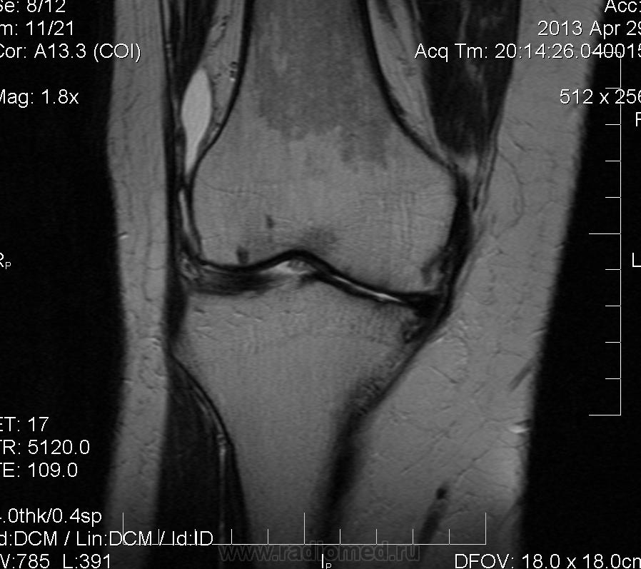 Отек костного мозга коленного сустава
