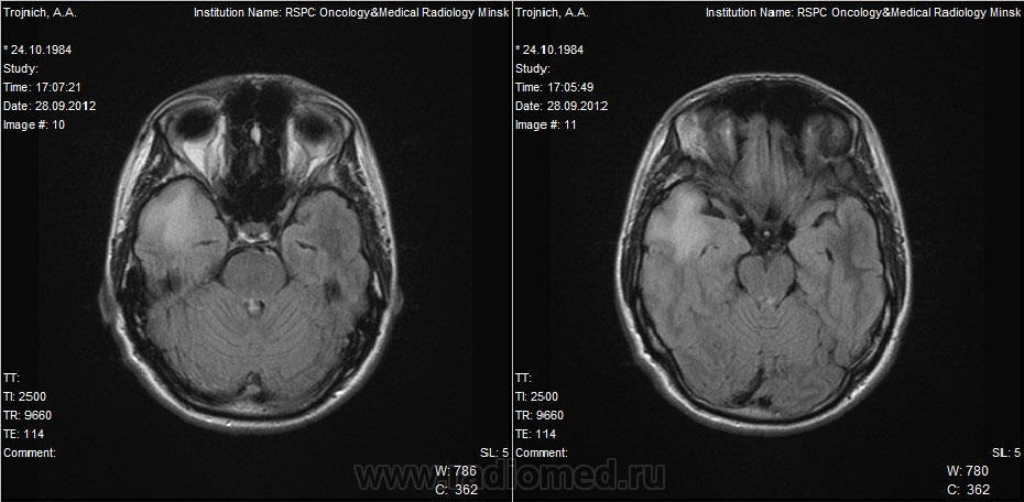 Мрт мозга ульяновске цены. Кт головного мозга снимки. Кт головного мозга снимки МОПСА. Кт головы Минусинск.