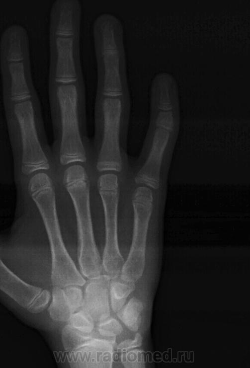 Трещина фаланги. Оскольчатый перелом фаланги пальца. Перелом фаланги мизинца рентгенограмма. Перелом средней фаланги пальца руки. Перелом ногтевой фаланги пальца на руке.