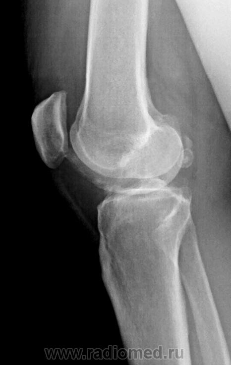 Трещина в коленной. Менископатия коленного сустава рентген. Трещина в мениске коленного.