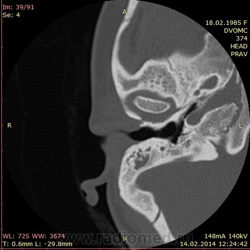 Средний отит кт картина