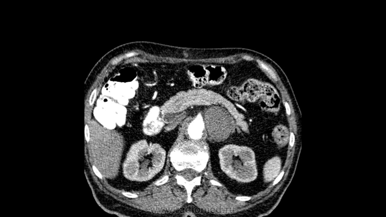 Кт забрюшинного пространства. Параганглиома забрюшинная. Параганглиома забрюшинного пространства. Параганглиома забрюшинного пространства кт. Параганглиома забрюшинная на кт.