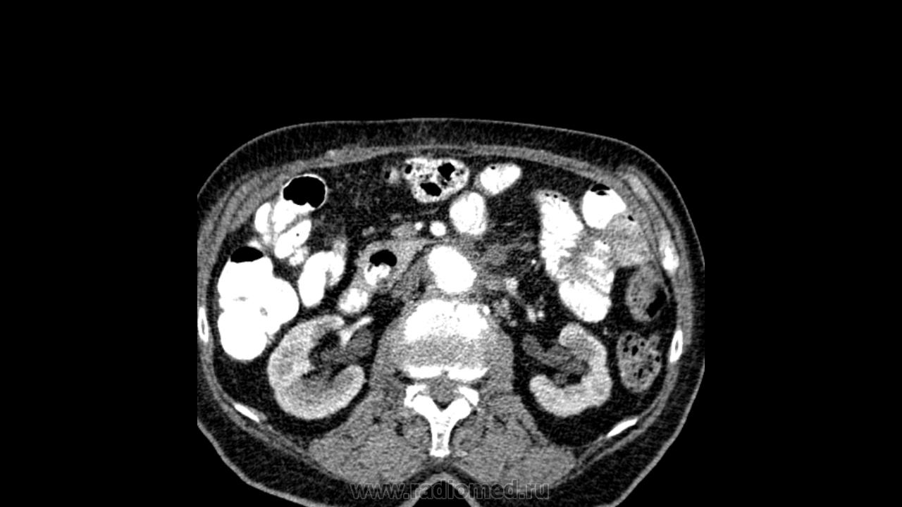 Кт забрюшинного пространства. Киста забрюшинного пространства кт. Ганглионеврома забрюшинного пространства. Забрюшинная опухоль кт.