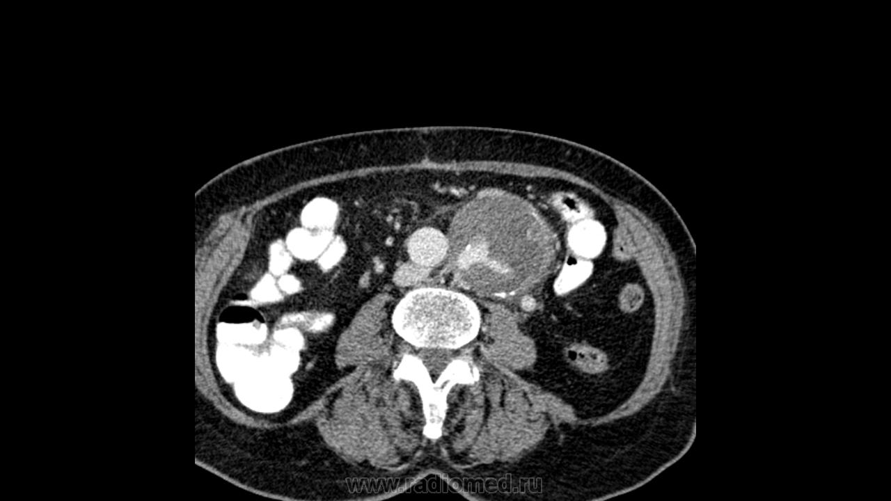 Кт забрюшинного пространства. Параганглиома забрюшинного пространства. Параганглиома забрюшинного пространства кт. Образование забрюшинного пространства Генезис. Опухоль забрюшинного пространства 16 на 5 см.