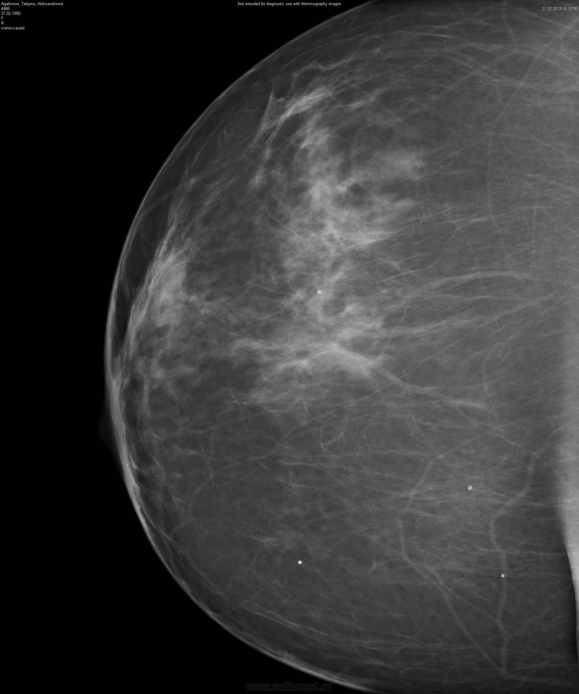 Прицельная маммография молочной железы