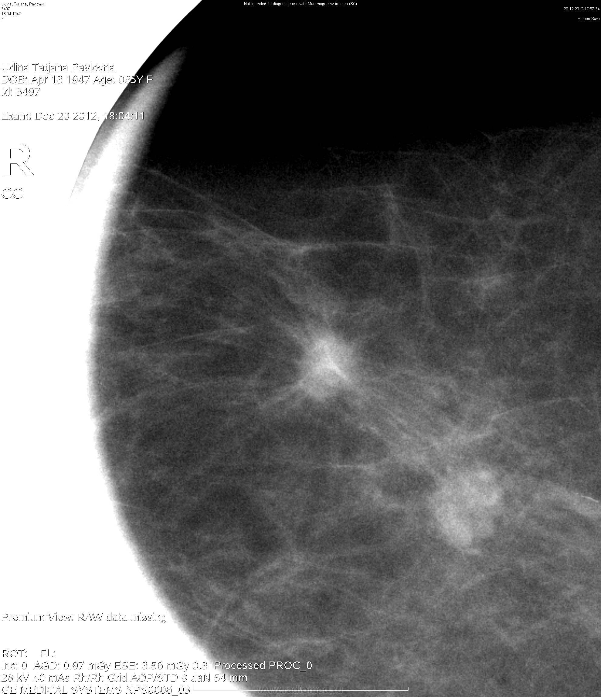 Интрамаммарный лимфоузел маммограмма