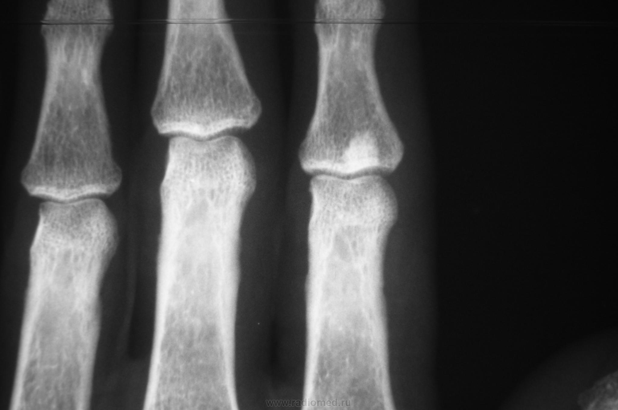 Рентген остеосклероз костной ткани