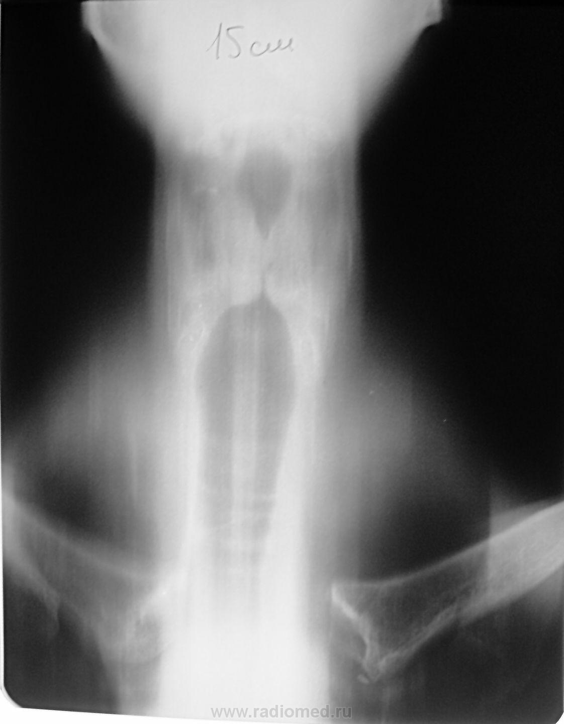 Рентгенография гортани
