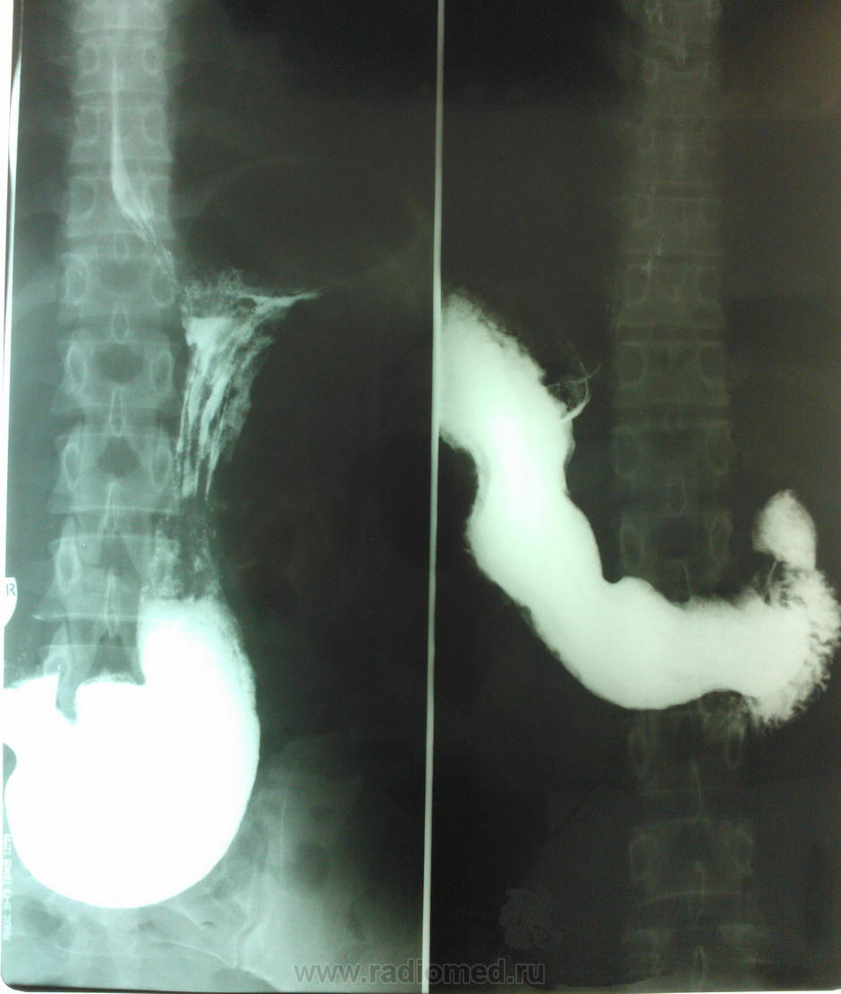 Рентгеноскопия желудка