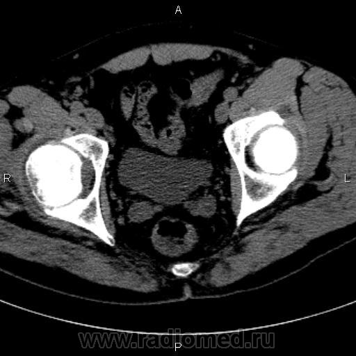 Кт тазобедренного сустава