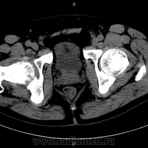 Кт тазобедренного сустава фото