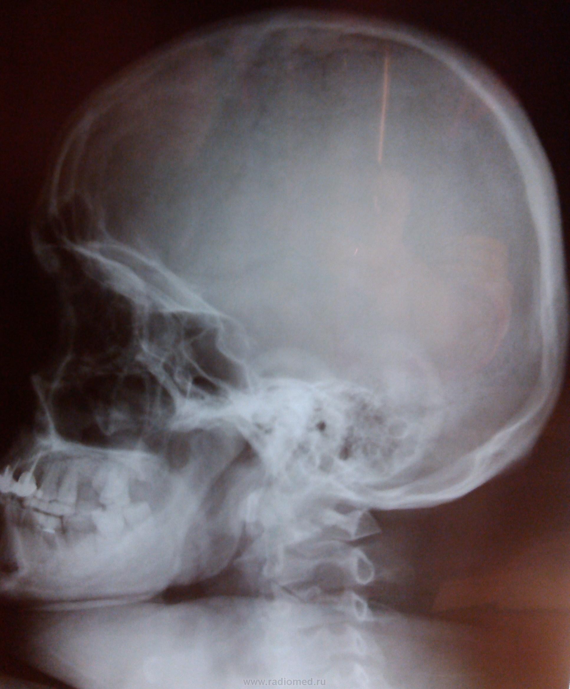 Сотрясение черепа. Рентген черепа сотрясение мозга. Вдавленный перелом черепа рентген. Рентген черепа Кеннеди.